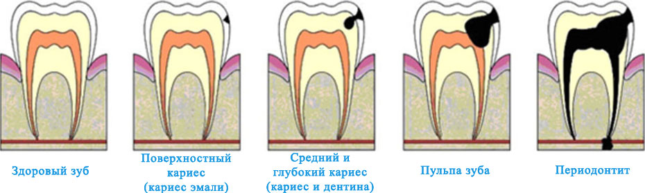 Виды кариеса у зуба