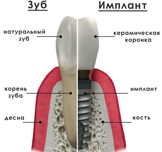 Коронка на имплант Коронка на имплант