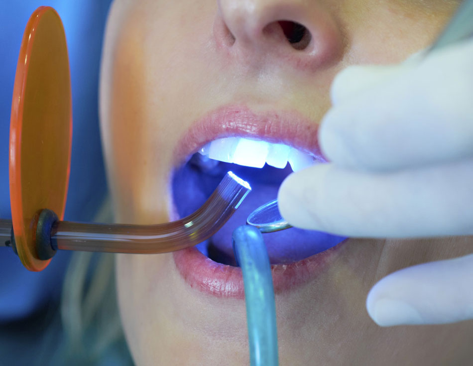 Лечение зубов при помощи лазера