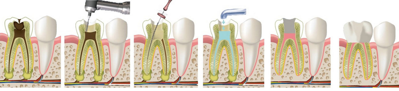 Эндодонтическое лечение корневых