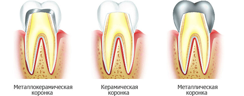 Виды коронок на зуб